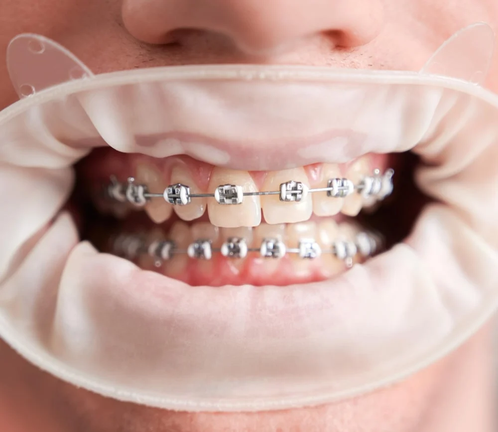 male-patient-with-cofferdam-mouth-showing-teeth-with-braces-min.webp